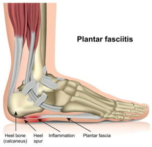 plantar fasciitis